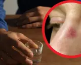 Czerwona plama na twarzy, widoczna po spożyciu alkoholu, może świadczyć o uczuleniu na alkohol.