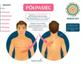 Ilustracja pokazuje, jak wygląda półpasiec: bolesna wysypka w formie pasa pęcherzy na tułowiu, spowodowana wirusem VZV.