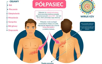 Ilustracja pokazuje, jak wygląda półpasiec: bolesna wysypka w formie pasa pęcherzy na tułowiu, spowodowana wirusem VZV.