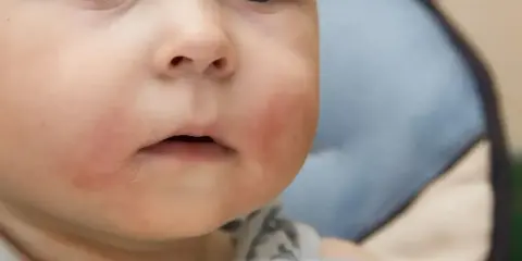 Czerwone policzki u rocznego dziecka mogą świadczyć o alergii pokarmowej.