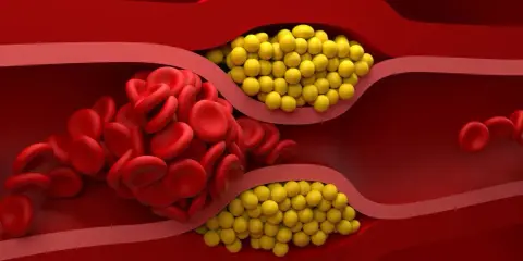 Zator w naczyniu krwionośnym: czerwone krwinki i żółte złogi cholesterolu nie-hdl blokują przepływ.