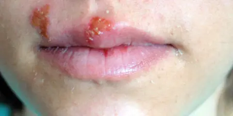 Opryszczka na ustach i policzku. Szukasz domowych sposobów na opryszczkę? Zobacz, jak szybko pozbyć się tej uciążliwej dolegliwości.