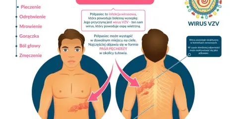 Ilustracja pokazuje, jak wygląda półpasiec: bolesna wysypka w formie pasa pęcherzy na tułowiu, spowodowana wirusem VZV.