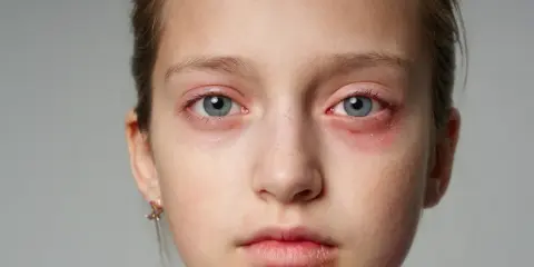 Czerwona, swędząca wysypka na twarzy dziewczynki, szczególnie wokół oczu i ust, sugeruje alergię lub podrażnienie.