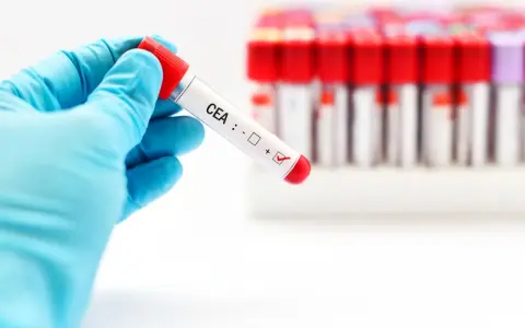 Rękawiczka trzyma probówkę z oznaczeniem CEA, gdzie zaznaczono wynik dodatni. To badanie jest kluczowe w diagnostyce.