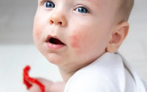 Małe dziecko z niebieskimi oczami i zaczerwienionymi policzkami, na których widoczna jest wysypka alergiczna.