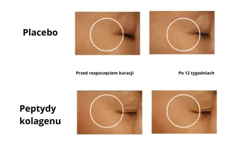 Porównanie efektów kolagenu do picia: skóra przed i po 12 tygodniach kuracji. Zmniejszenie zmarszczek wokół oka.
