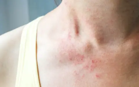 Czerwona, swędząca wysypka na szyi i klatce piersiowej, typowe objawy alergii pokarmowej na skórze.
