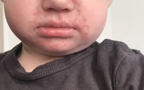 Czerwona wysypka wokół ust u niemowlaka, która może być spowodowana ślinieniem lub jedzeniem.