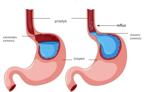 Schemat żołądka z otwartym zwieraczem, pokazujący refluks i powodujący pieczenie w żołądku.