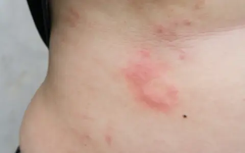 Czerwone, swędzące plamy na skórze, które mogą być objawem uczulenia na soję.
