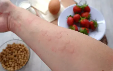 Czerwone, swędzące bąble na skórze, przypominające objawy alergii u dzieci 3 letnich, po kontakcie z truskawkami i jajkiem.