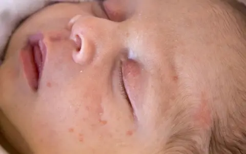 Skóra niemowlęcia z zaczerwienieniami i krostkami. Czy to trądzik niemowlęcy, czy może alergia?