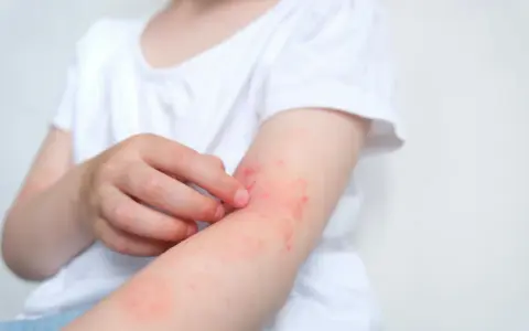 Dziecko drapie zaczerwienioną skórę na ramieniu, objaw gorączki przy alergii.