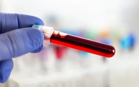 Ręka w niebieskiej rękawiczce trzyma probówkę z krwią do badania, np. czasu protrombinowego.
