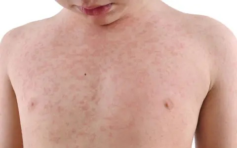 Dziecko z wysypką na klatce piersiowej, która może być objawem alergii wziewnej.