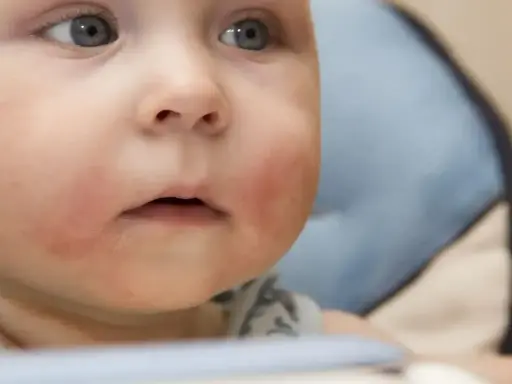 Czerwone policzki u rocznego dziecka mogą świadczyć o alergii pokarmowej.
