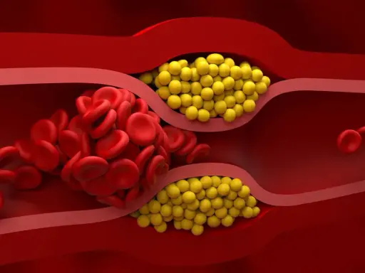 Zator w naczyniu krwionośnym: czerwone krwinki i żółte złogi cholesterolu nie-hdl blokują przepływ.