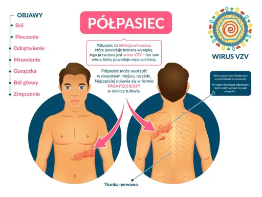 Ilustracja pokazuje, jak wygląda półpasiec: bolesna wysypka w formie pasa pęcherzy na tułowiu, spowodowana wirusem VZV.