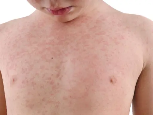Dziecko z wysypką na klatce piersiowej, która może być objawem alergii wziewnej.