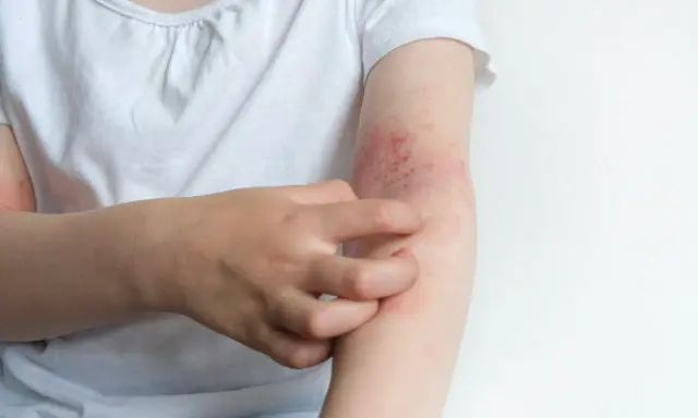 Dziecko drapie swędzącą rękę z zaczerwienioną skórą, objawem co to jest atopowe zapalenie skóry.