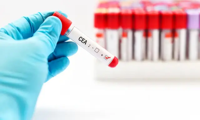 Rękawiczka trzyma probówkę z oznaczeniem CEA, gdzie zaznaczono wynik dodatni. To badanie jest kluczowe w diagnostyce.