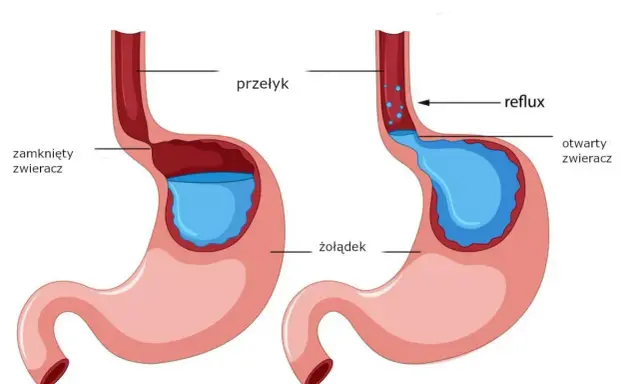 Schemat żołądka z otwartym zwieraczem, pokazujący refluks i powodujący pieczenie w żołądku.