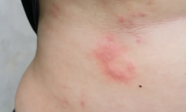 Czerwone, swędzące plamy na skórze, które mogą być objawem uczulenia na soję.