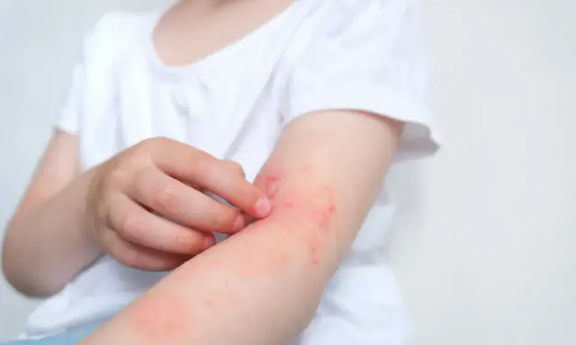 Dziecko drapie zaczerwienioną skórę na ramieniu, objaw gorączki przy alergii.