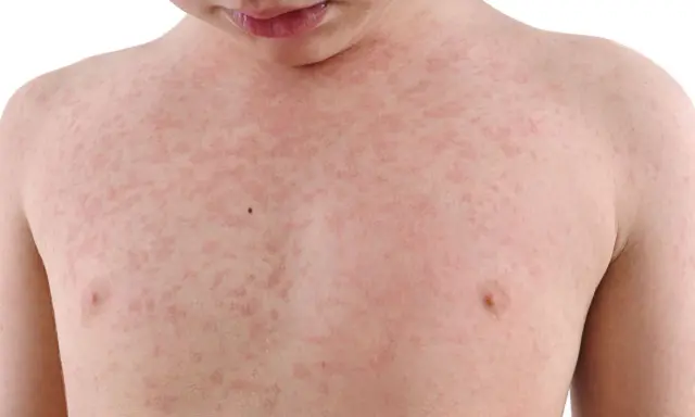 Dziecko z wysypką na klatce piersiowej, która może być objawem alergii wziewnej.